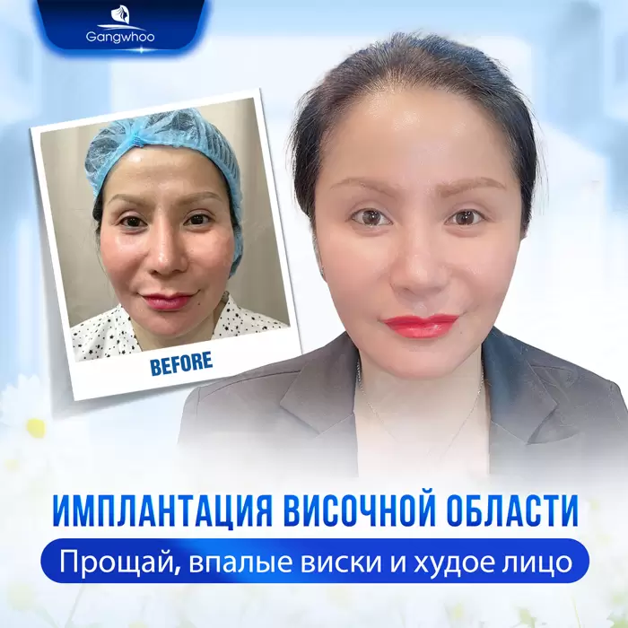 Увеличение висков: секрет утонченного и полного жизни лица 1 ru don thai duong 2