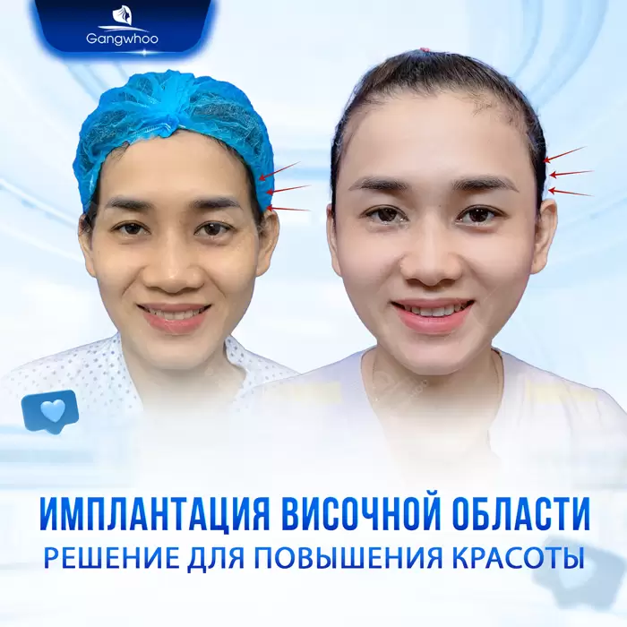 Увеличение висков: секрет утонченного и полного жизни лица 4 ru don thai duong 3
