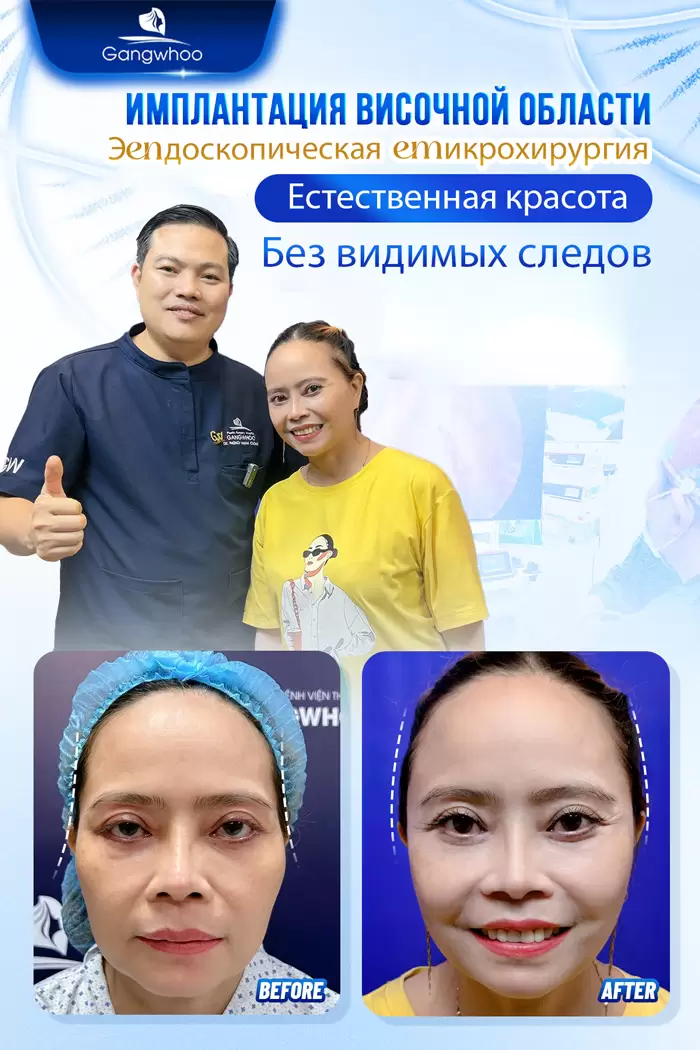 Увеличение висков: секрет утонченного и полного жизни лица 3 ru don thai duong 4