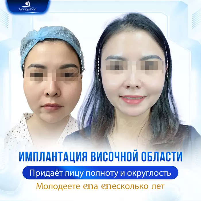 Увеличение висков: секрет утонченного и полного жизни лица 19 ru don thai duong 6