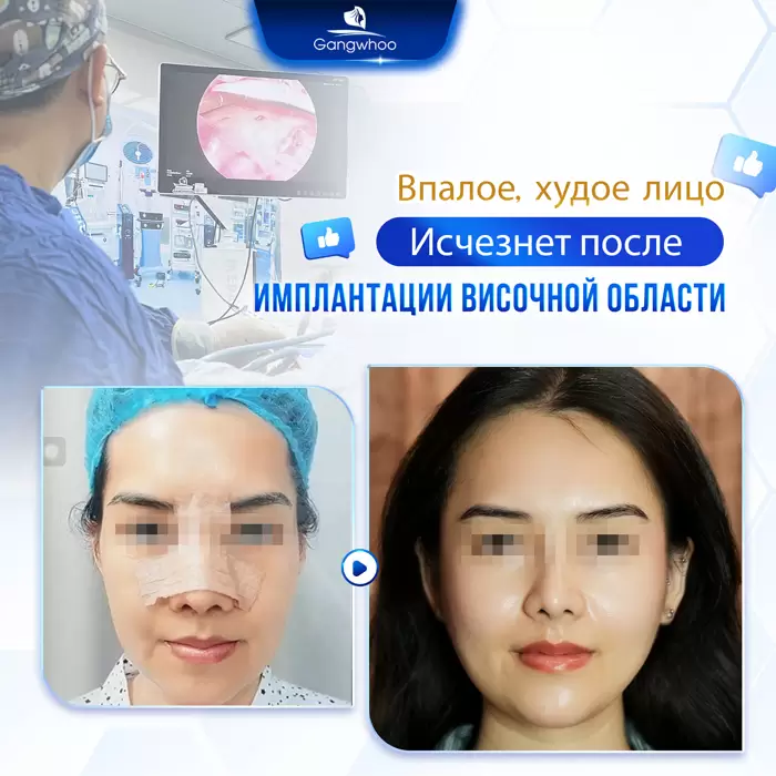 Увеличение висков: секрет утонченного и полного жизни лица 18 ru don thai duong 7