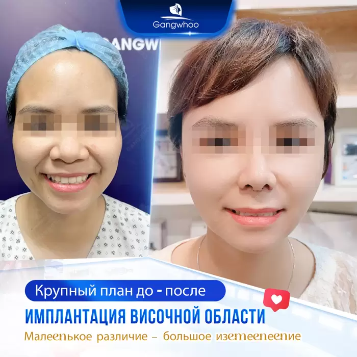 Увеличение висков: секрет утонченного и полного жизни лица 2 ru don thai duong 8