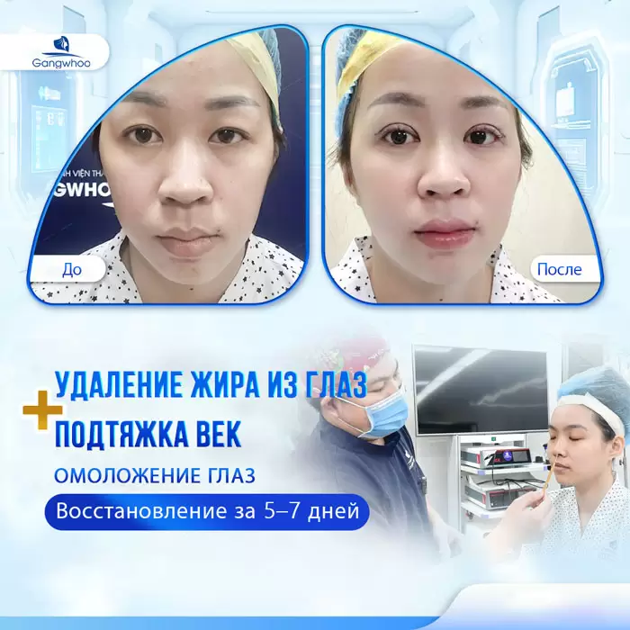 ru lay mo mat noi soi 1