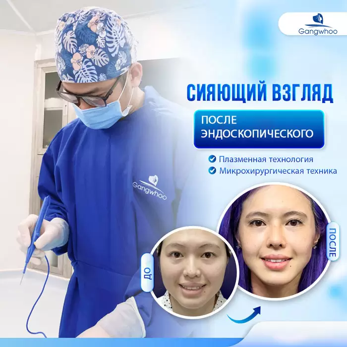 ru lay mo mat noi soi 2