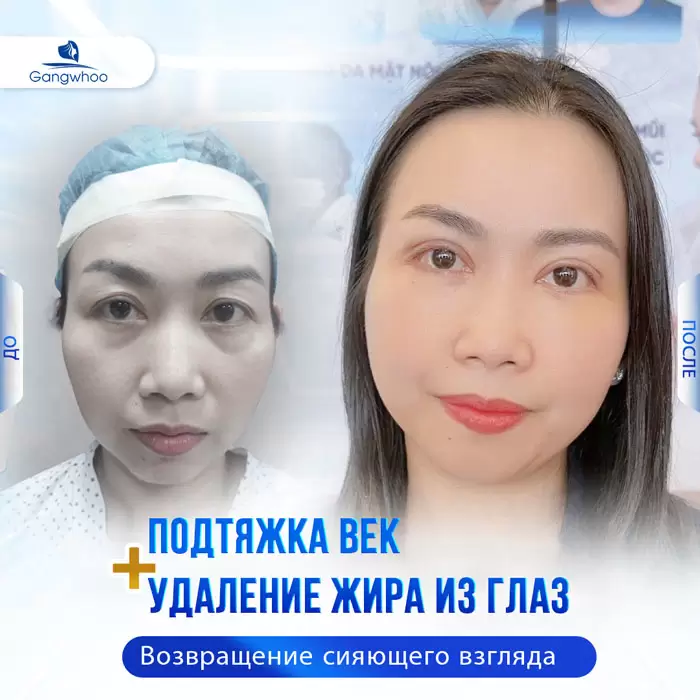 ru lay mo mat noi soi 4