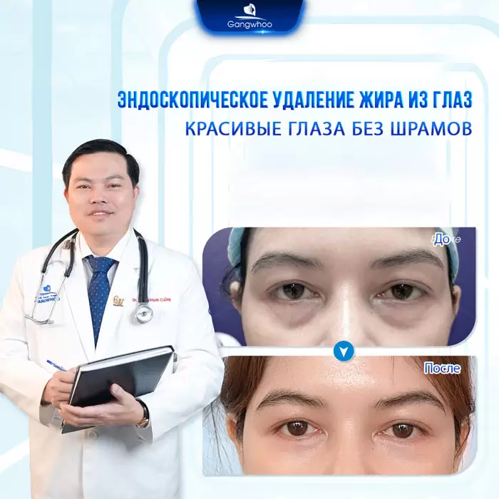 ru lay mo mat noi soi 6