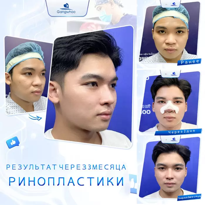 ru nang mui cau truc 2