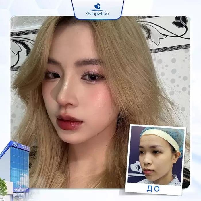 ru nang mui cau truc 3