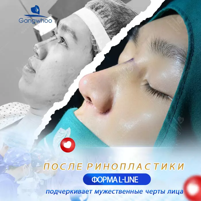 ru nang mui cau truc 4