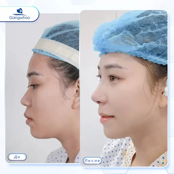 ru nang mui cau truc 5