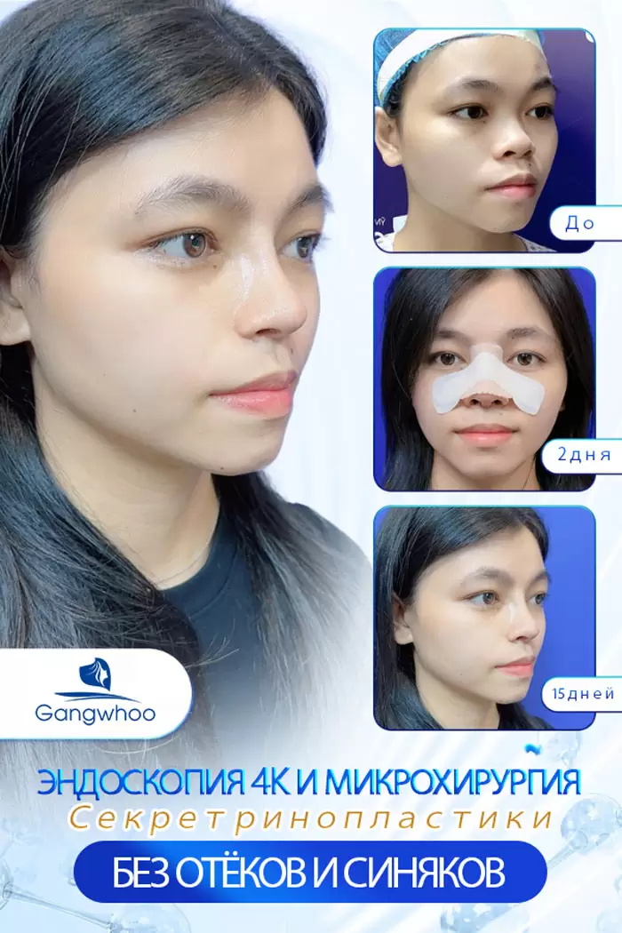 ru nang mui cau truc 6