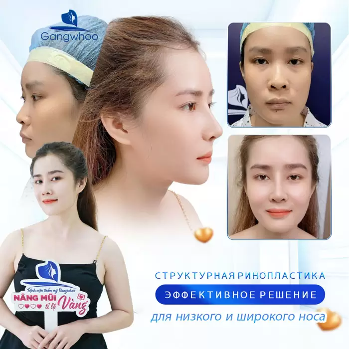 ru nang mui cau truc 7