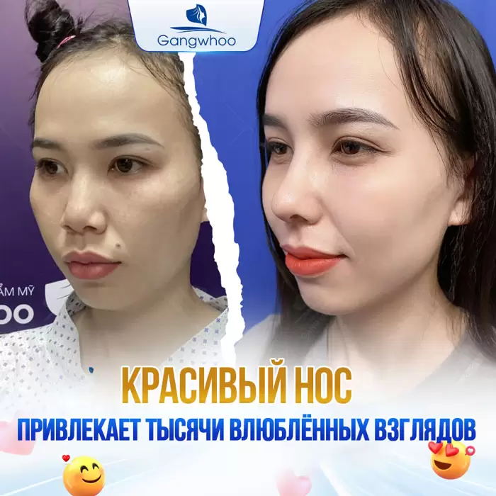 ru nang mui sun suon 5