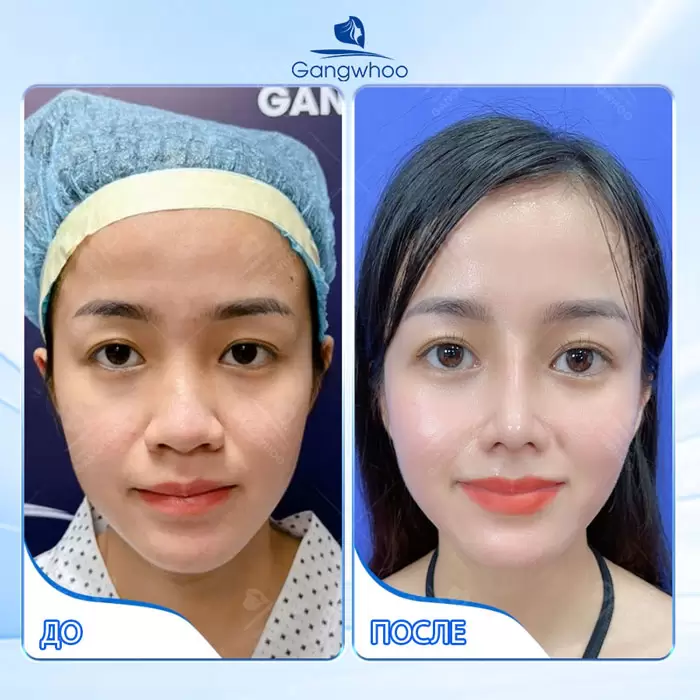 ru thu gon canh mui 1