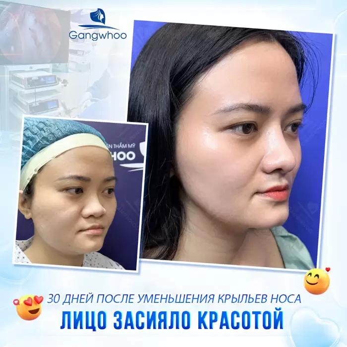 ru thu gon canh mui 3