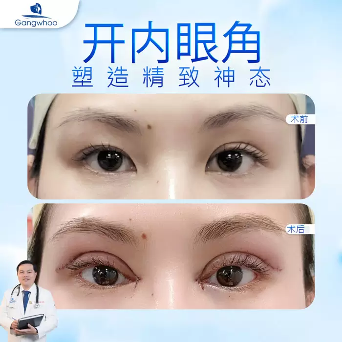 zh mo goc mat trong 3