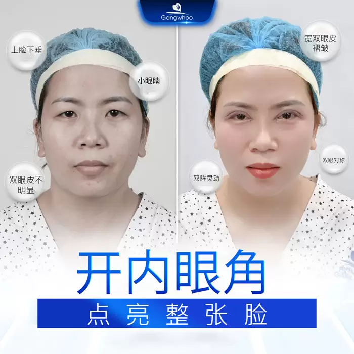 zh mo goc mat trong 5