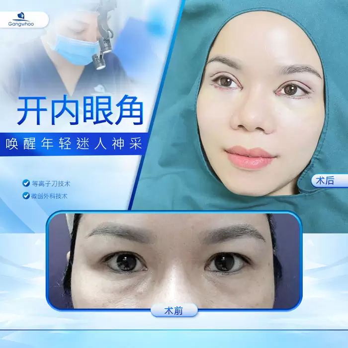 zh mo goc mat trong 6