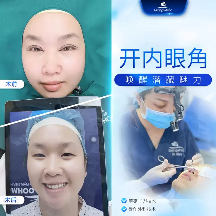 zh mo goc mat trong 8