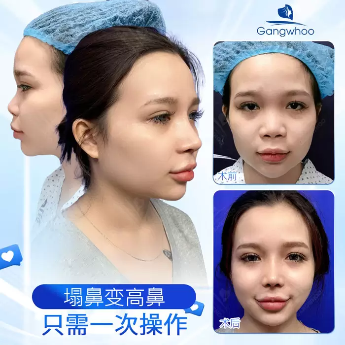 zh nang mui surgiform 2