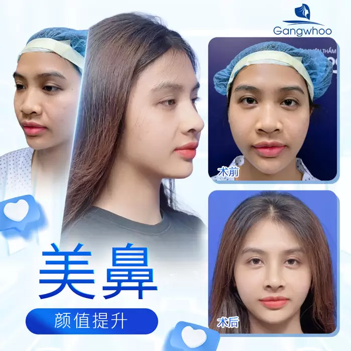 zh nang mui surgiform 6