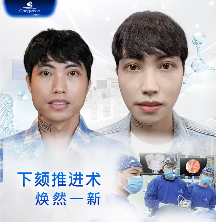 zh truot cam 1