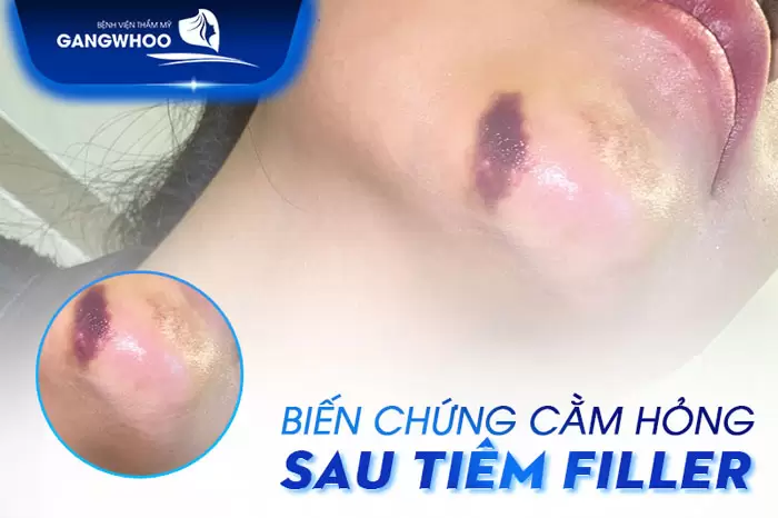 Biến Chứng Tiêm Filler Cằm: Dấu Hiệu - Nguyên Nhân Và Cách Xử Lý 1 Biến Chứng Tiêm Filler Cằm: Dấu Hiệu - Nguyên Nhân Và Cách Xử Lý