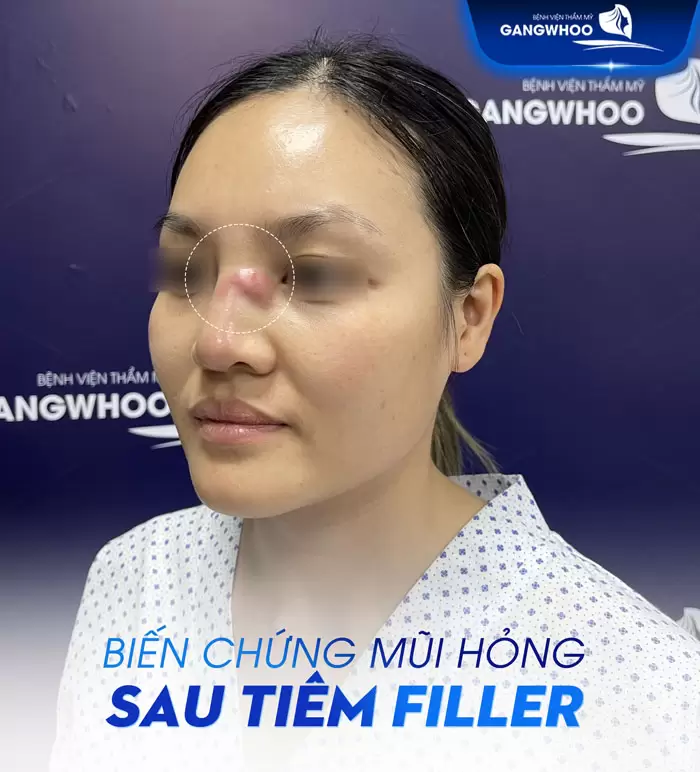 Biến Chứng Tiêm Filler Mũi: Nhận Biết Sớm & Xử Lý Sớm Để Tránh Hậu Quả 1 Biến Chứng Tiêm Filler Mũi: Nhận Biết Sớm & Xử Lý Sớm Để Tránh Hậu Quả