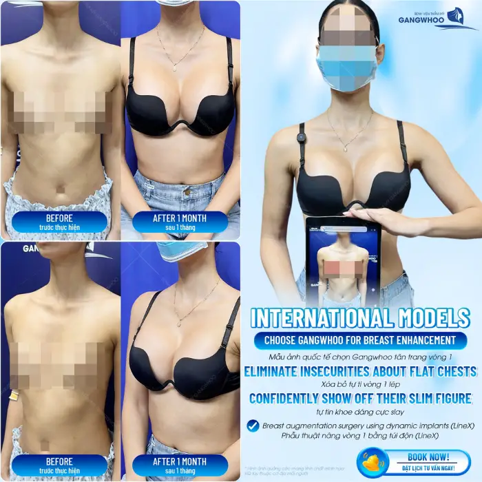 breast augmentation line