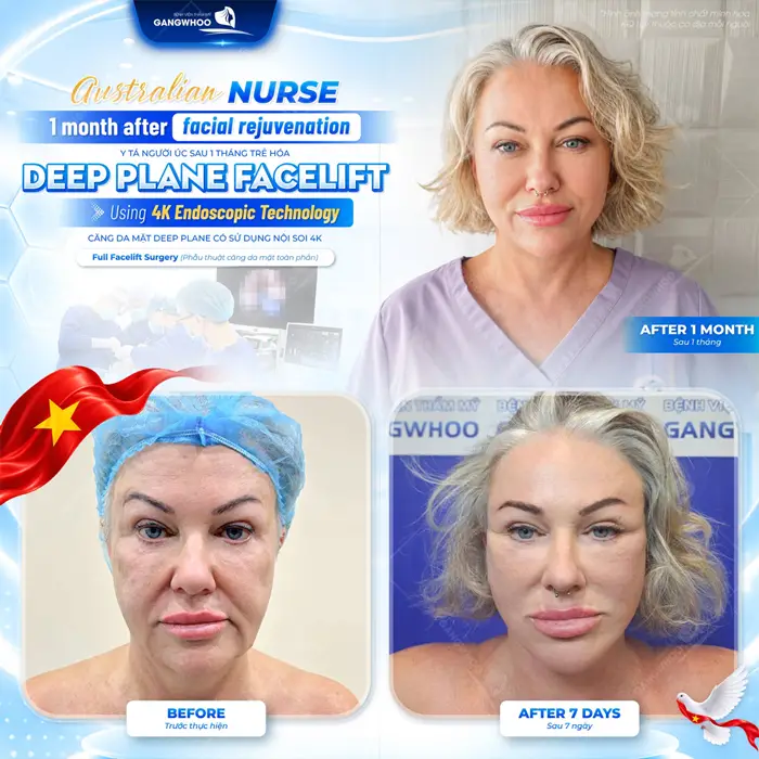 Y tá người Úc sau 1 tháng trẻ hóa diện mạo có sử dụng nội soi 4K gương mặt ngày càng tươi tắn và rạng rỡ hơn