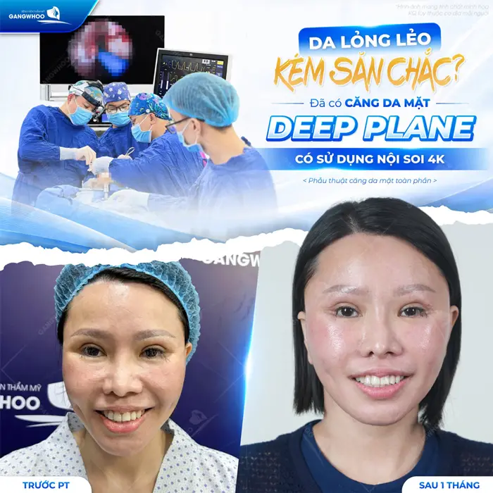 Căng Da Mặt Deep Plane: Giải Pháp Trẻ Hóa Làn Da Toàn Diện & An Toàn 18 Da lỏng lẻo và kém săn chắc đã có căng da mặt Deep Plane sử dụng nội soi 4K tạm biệt nếp nhăn nhão chùng hiệu quả