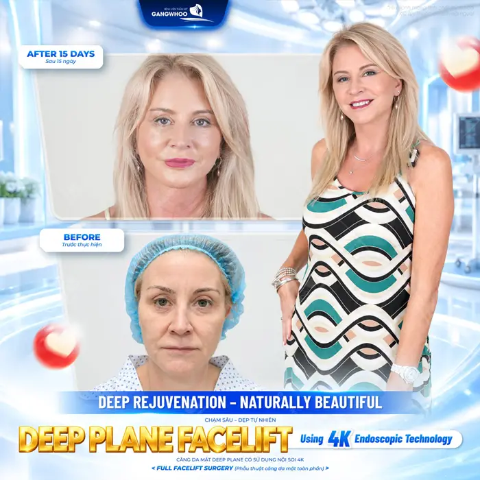 Căng da mặt Deep Plane có sử dụng nội soi 4K kết quả sau 15 ngày thực hiện diện mạo trẻ, gương mặt tươi tắn hơn 