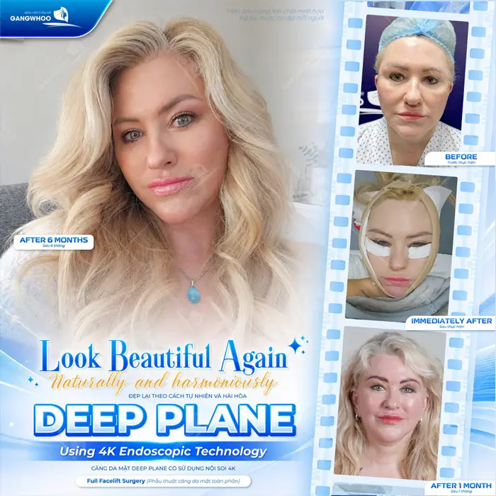 Căng da mặt Deep Plane diện mạo trẻ đẹp trẻ hóa an toàn và dài lâu