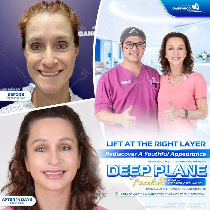Căng Da Mặt Deep Plane: Giải Pháp Trẻ Hóa Làn Da Toàn Diện & An Toàn 6 Căng da mặt Deep Plane giải pháp trẻ hóa làn da đẹp toàn diện, an toàn và hiệu quả dài lâu