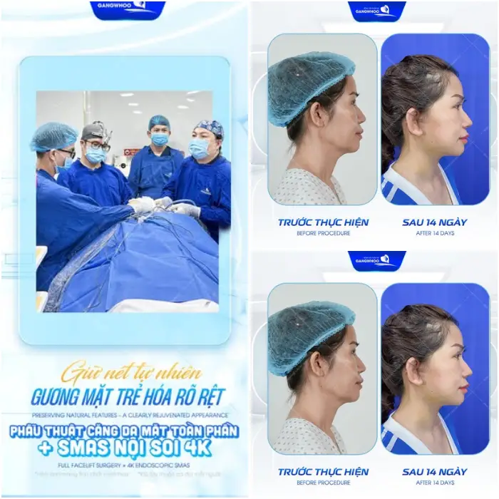 Trẻ hóa toàn diện với căng da SMAS 4K: Da căng mịn, không đơ cứng