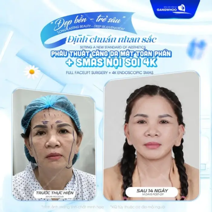 Căng da mặt toàn phần – Tái tạo đường nét thanh xuân, da căng mịn tự nhiên