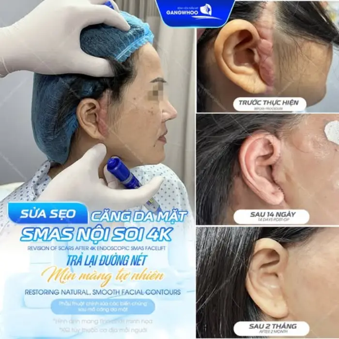 Chỉnh sửa biến chứng căng da mặt: Xử lý sẹo lồi, tái cấu trúc gương mặt tự nhiên