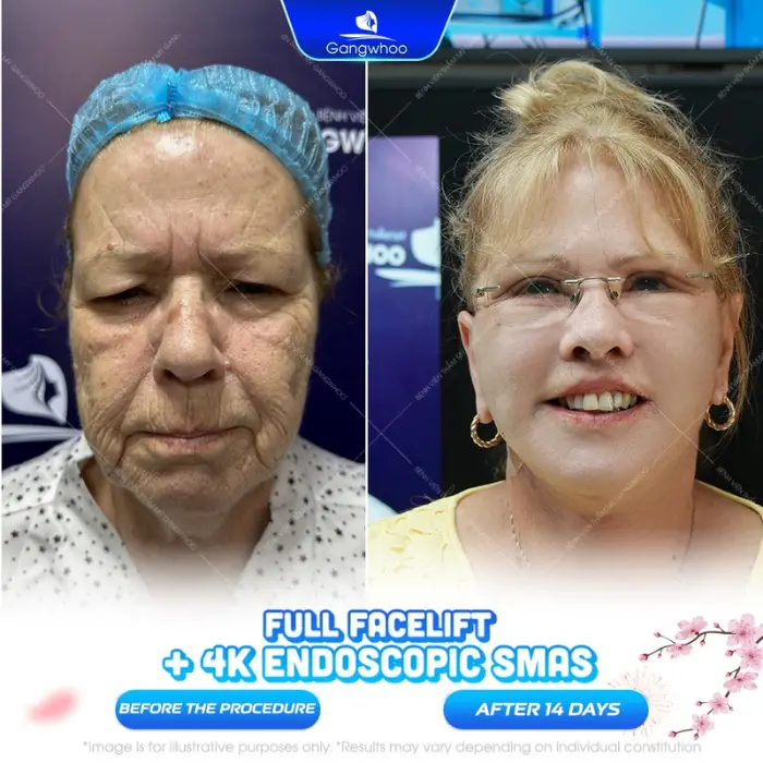 deep plane facelift 1