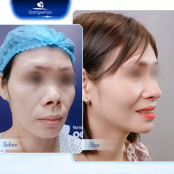 en bien chung tiem filler sau nang mui 2