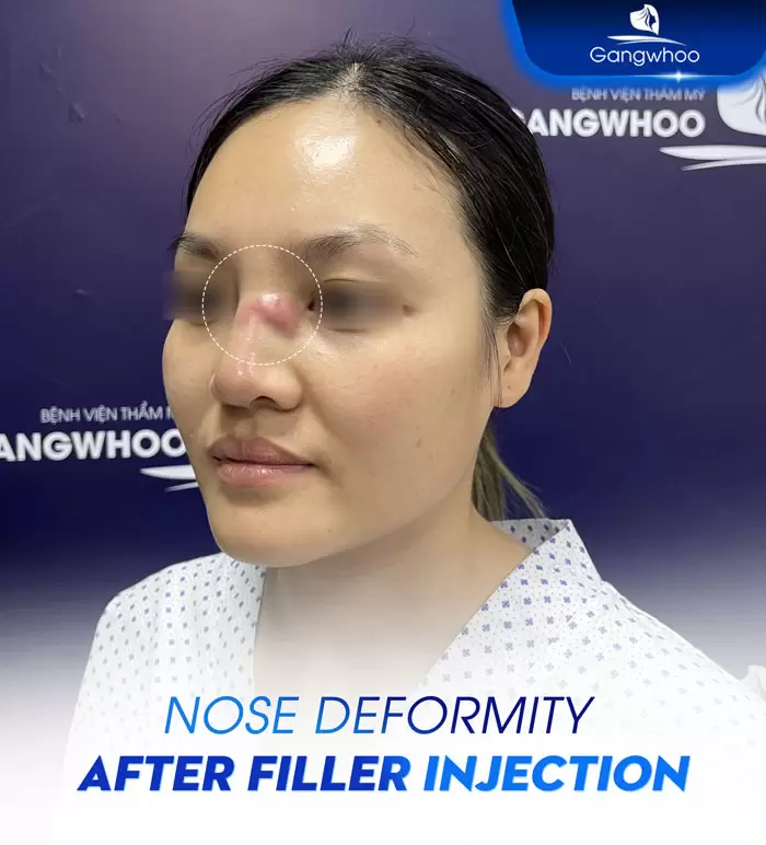 en bien chung tiem filler sau nang mui 4