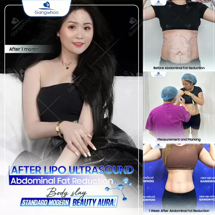 Safe Liposuction Guide for International Clients in Vietnam 2 en cam nang hut mo cho khach quoc te 1