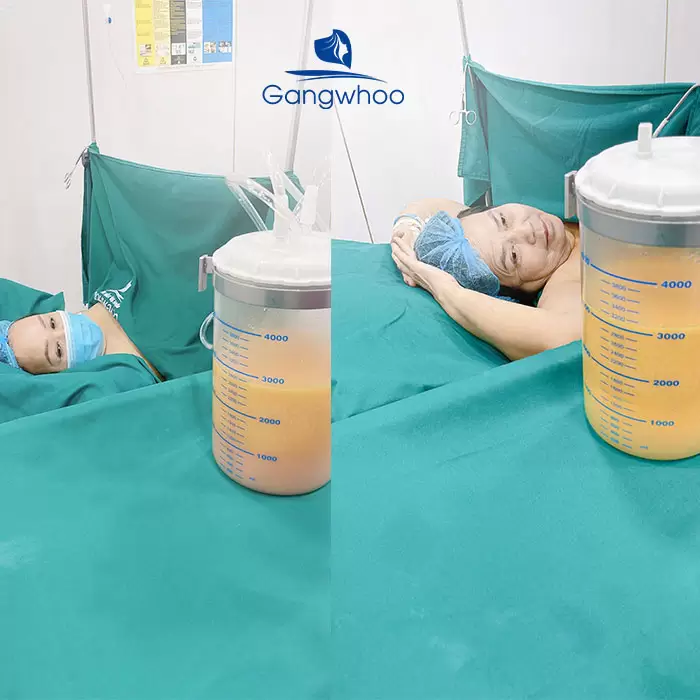 Safe Liposuction Guide for International Clients in Vietnam 3 en cam nang hut mo cho khach quoc te 3