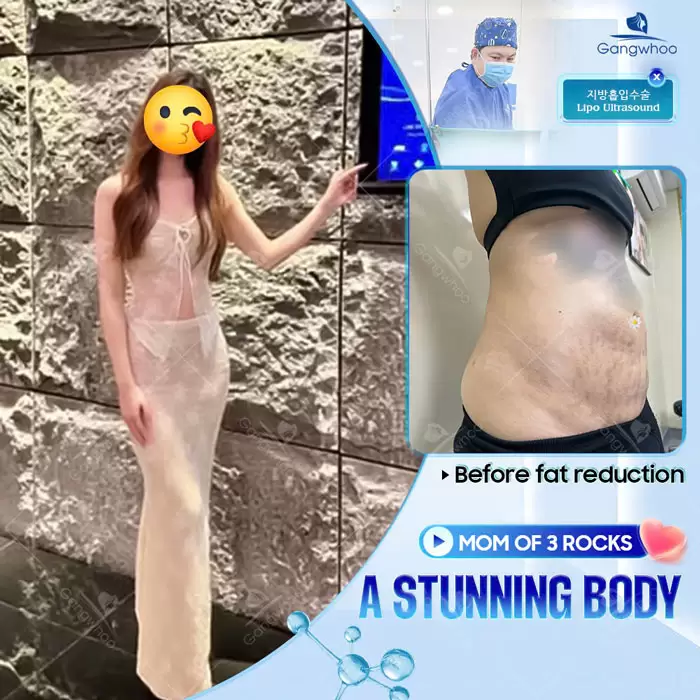 Safe Liposuction Guide for International Clients in Vietnam 4 en cam nang hut mo cho khach quoc te 5