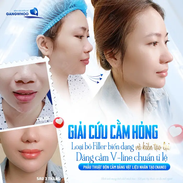 Giải cứu cằm hỏng loại bỏ filler biến dạng và kiến tạo lại dáng cằm đẹp chuẩn V line
