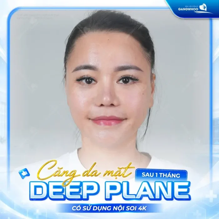 Căng Da Mặt Deep Plane: Giải Pháp Trẻ Hóa Làn Da Toàn Diện & An Toàn 17 ket qua cang da mat deep plane af 1 e1787193408302