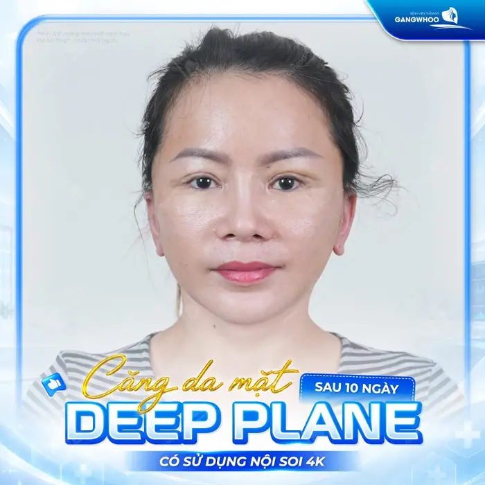 Căng Da Mặt Deep Plane: Giải Pháp Trẻ Hóa Làn Da Toàn Diện & An Toàn 15 ket qua cang da mat deep plane af 2