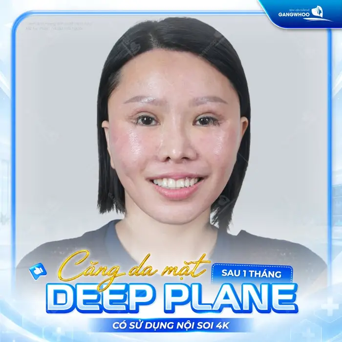 Căng Da Mặt Deep Plane: Giải Pháp Trẻ Hóa Làn Da Toàn Diện & An Toàn 13 ket qua cang da mat deep plane af 3