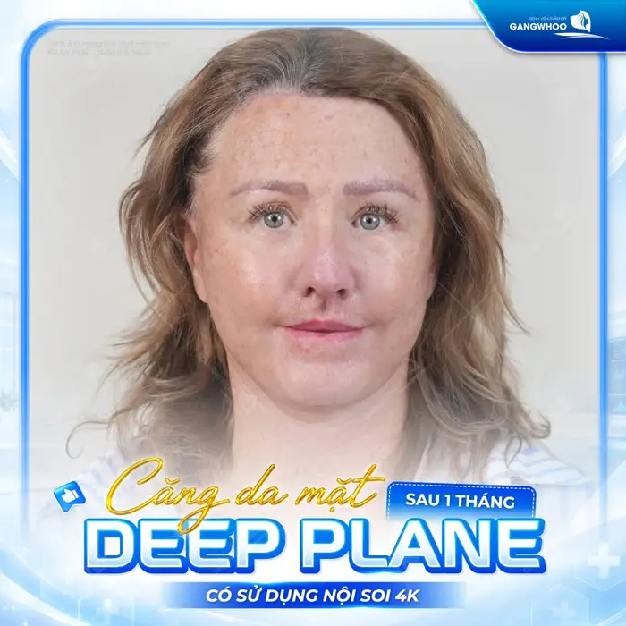Căng Da Mặt Deep Plane: Giải Pháp Trẻ Hóa Làn Da Toàn Diện & An Toàn 9 ket qua cang da mat deep plane af 4
