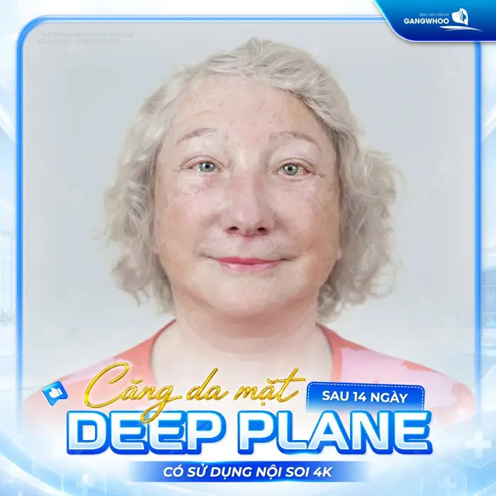 Căng Da Mặt Deep Plane: Giải Pháp Trẻ Hóa Làn Da Toàn Diện & An Toàn 11 ket qua cang da mat deep plane af 5