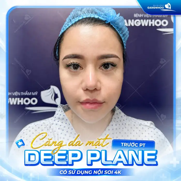 Căng Da Mặt Deep Plane: Giải Pháp Trẻ Hóa Làn Da Toàn Diện & An Toàn 16 ket qua cang da mat deep plane bf 1